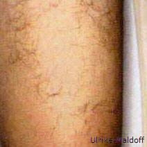 Haarentfenung mit Licht. am Bein, Bild von der Firma zur Verfügung gestellt. Ergebnis vor der dritten Behandlung.