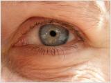 Feuchtikeitsarme Haut sieht man meisten als erstes an den Fältchen um die Augen.