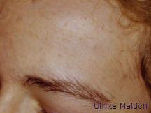 Schönes Hautbild nach Akne-Behandlung 