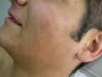 Pitanga-Haarentfernung ist schonend für die Haut, Behandlungserfolg nach acht Wochen.