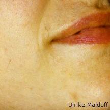 Haut nach 6 Monaten mit dermatologischer Hautpflege.